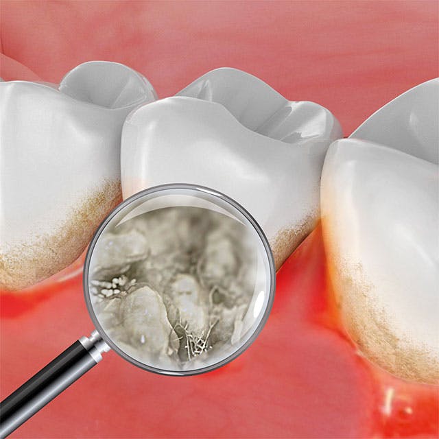 placadental